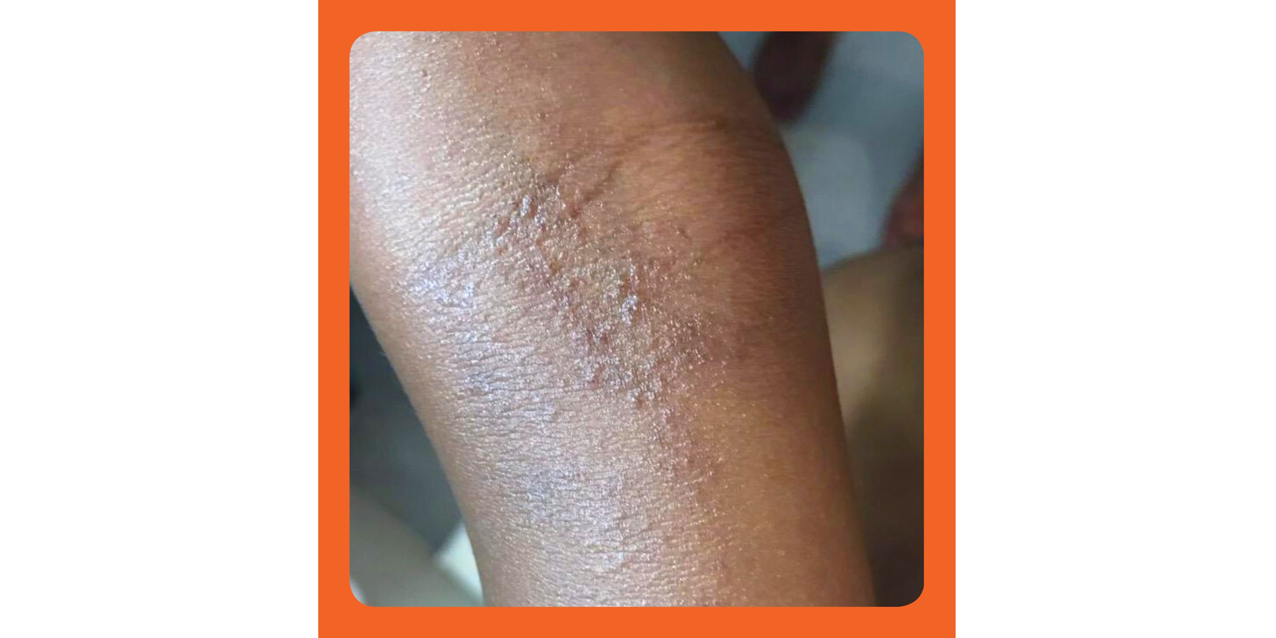 here-u2019s-how-eczema-on-black-skin-looks-different-and-how-to-treat