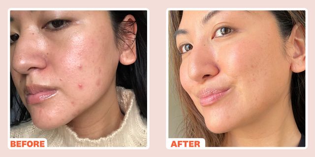 Radiofrequency Microneedling for Acne Scars Before and After