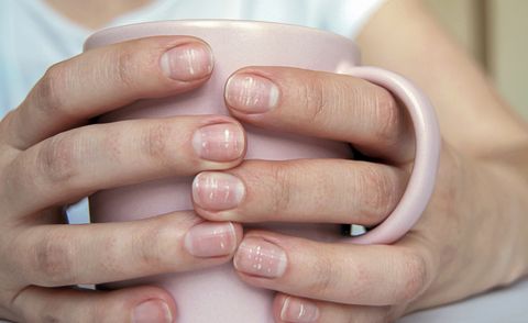 White Spots On Nails Leukonychia Causes Treatment And Prevention