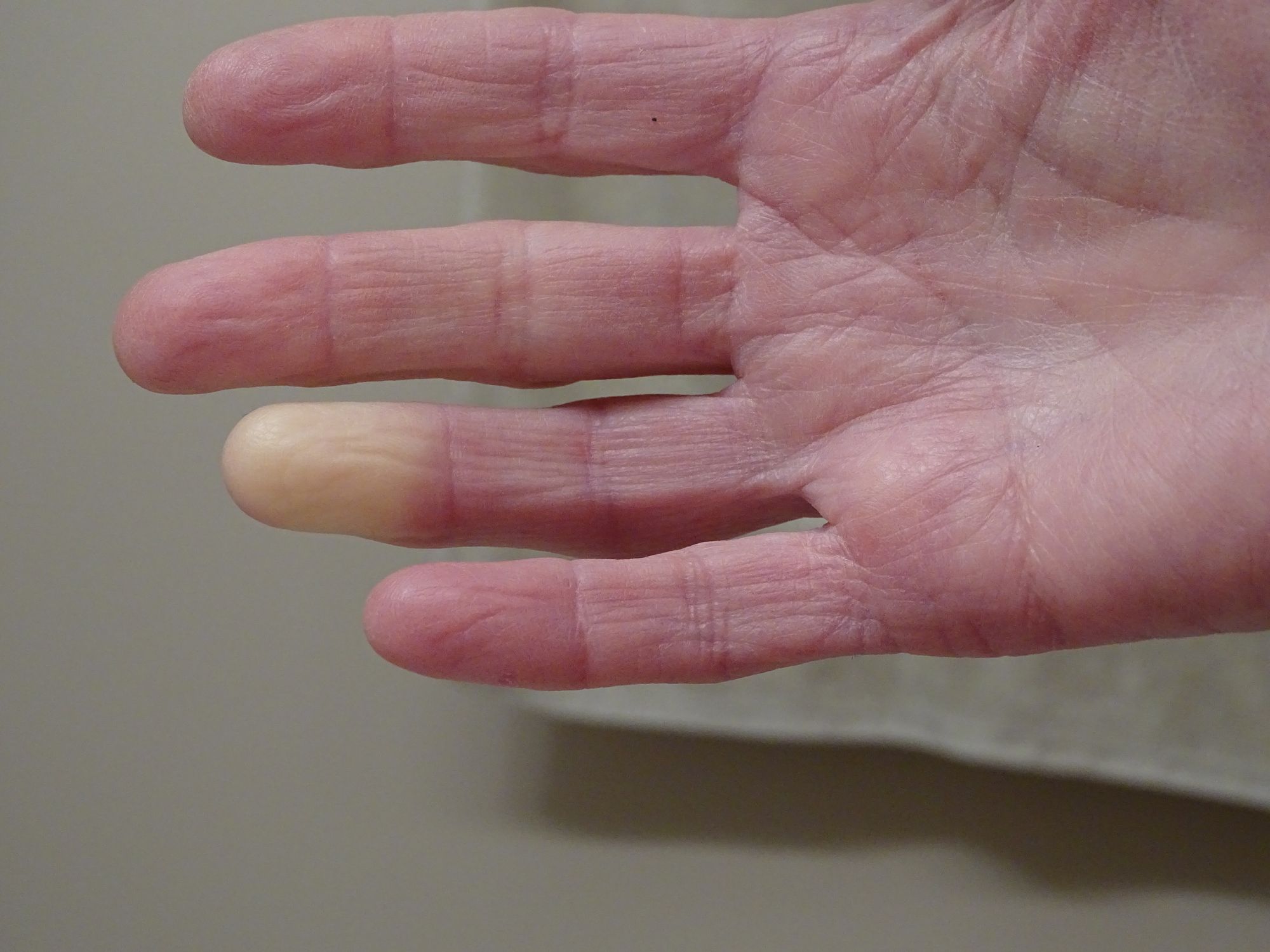 Witte gevoelloze vingers of het koud is? Dit kan de oorzaak zijn