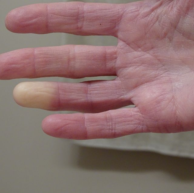 Nauwkeurigheid hefboom Zachtmoedigheid Witte gevoelloze vingers of tenen als het koud is? Dit kan de oorzaak zijn