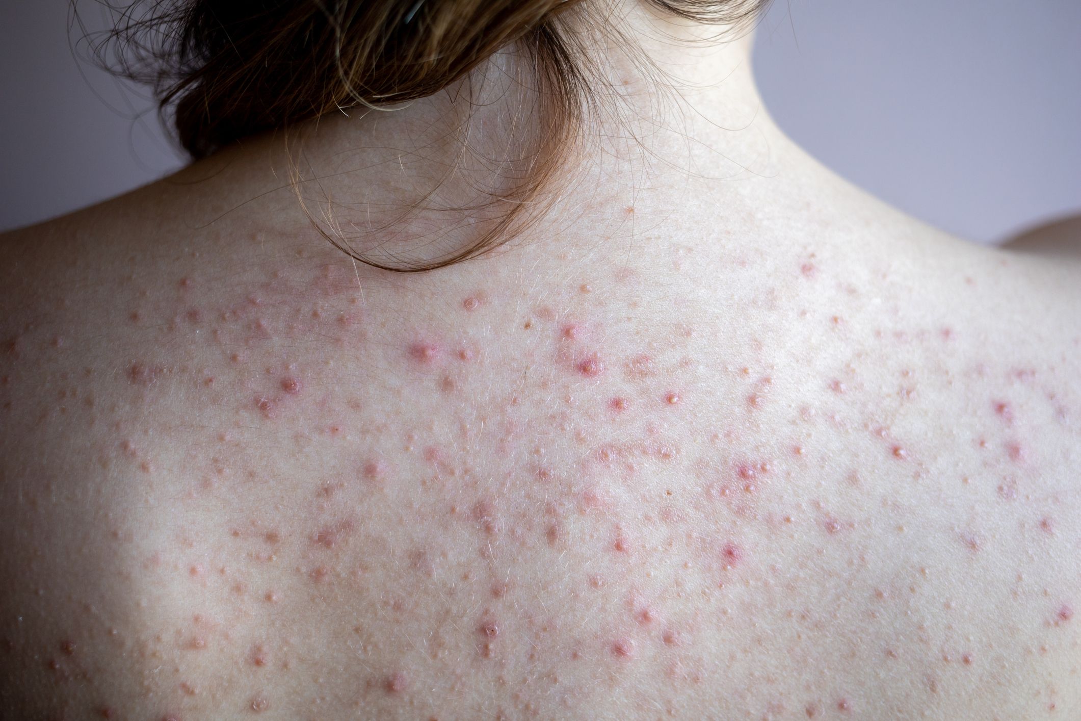 A Photo Guide To Raised Skin Bumps Red Moles Cysts And More