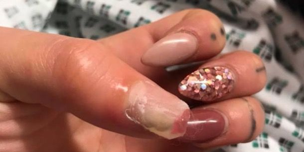 This Woman Almost Lost Her Thumb After Having Fake Nails