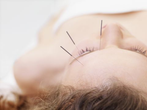 Woman receiving acupuncture