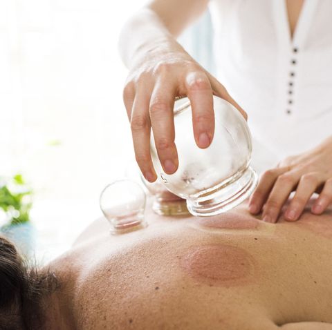what is cupping therapy