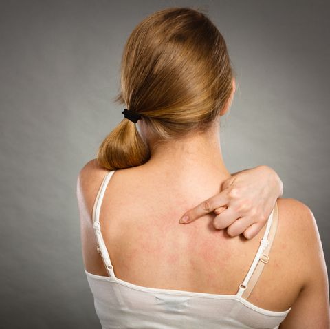 woman scratching her itchy back with allergy rash