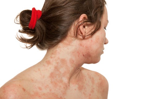 18 Common Skin Rash Pictures How To Id Skin Rash Symptoms