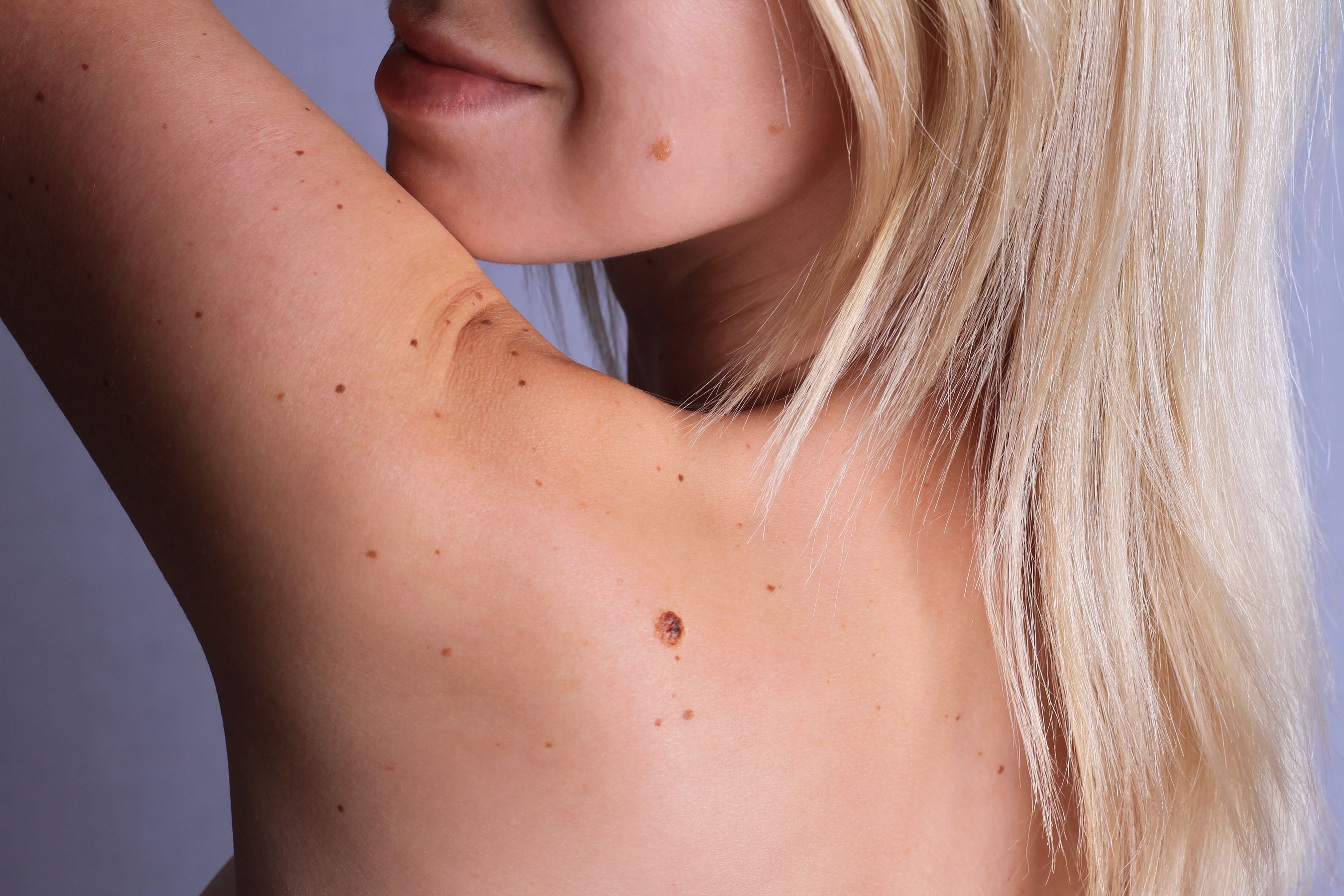 Melanoma Pictures & Symptoms - What Does Melanoma Look Like?