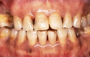 crack addiction teeth