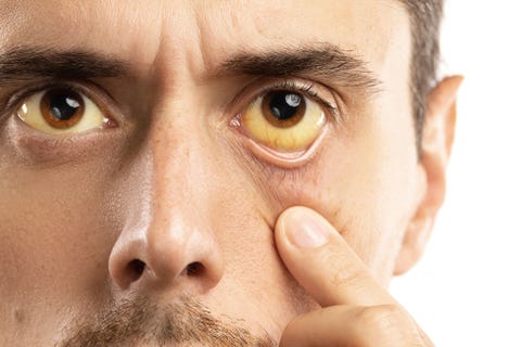 Pancreatic Cancer Symptoms - 8 Surprising Signs Men Should ...