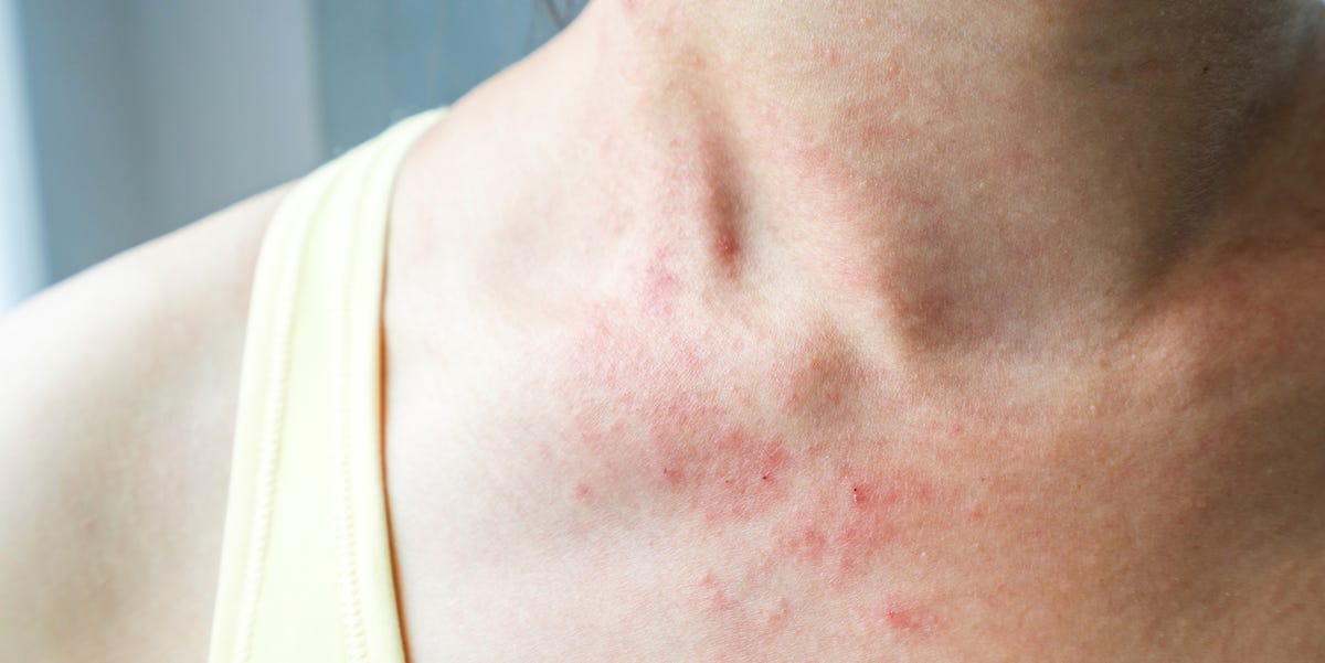 Why A Skin Rash May Be A Coronavirus Symptom According To Doctors