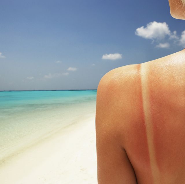 young woman on beach with sunburn, rear view