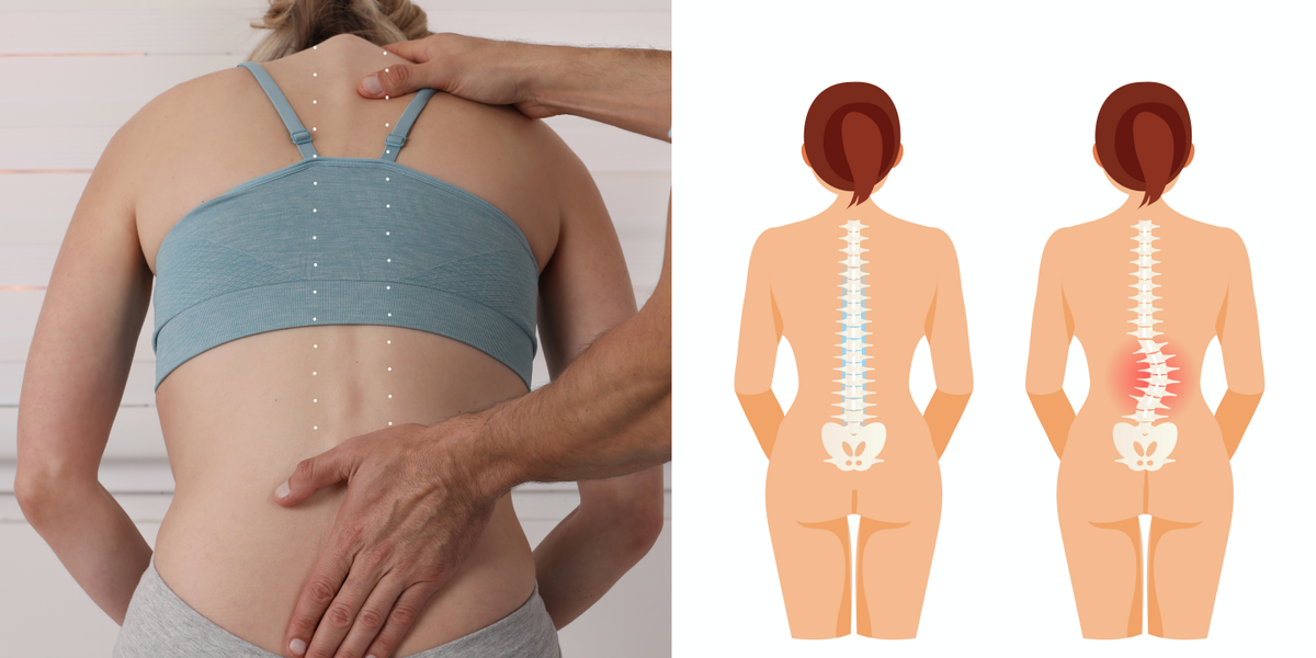 症 彎 脊柱 側 脊柱側彎症狀、成因、治療｜長短腳駝背易中招2個運動防腰痠背痛