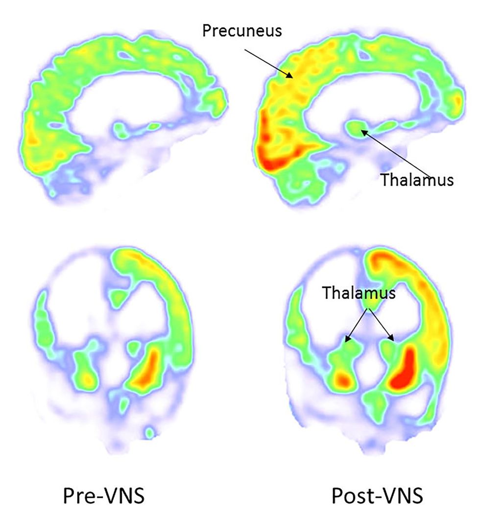 Brain scans of the patient showed increased activity in the right parietooccipital cortex thalamus and striatum after vagus nerve stimulation