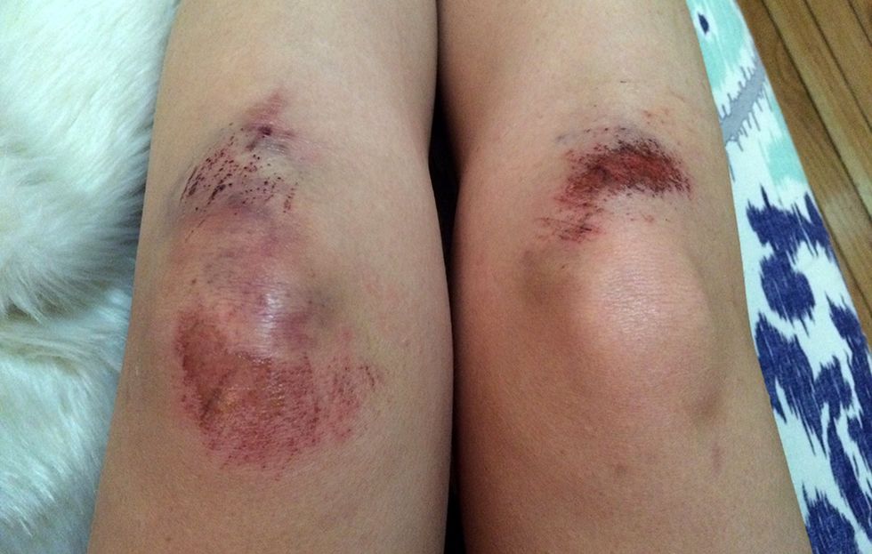 Bruised and scratched up knees