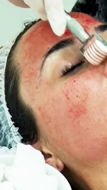 What Is Microneedling And Should You Do It