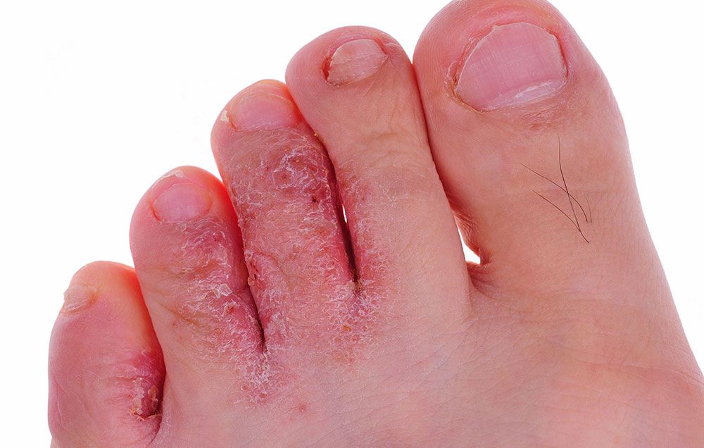 What Is a Staph Infection?