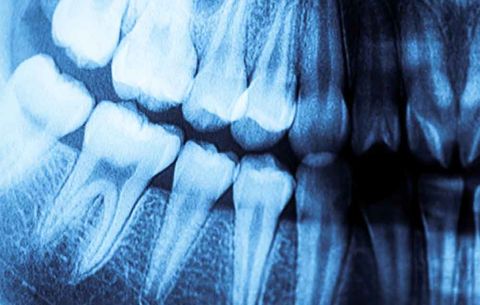 teeth x ray