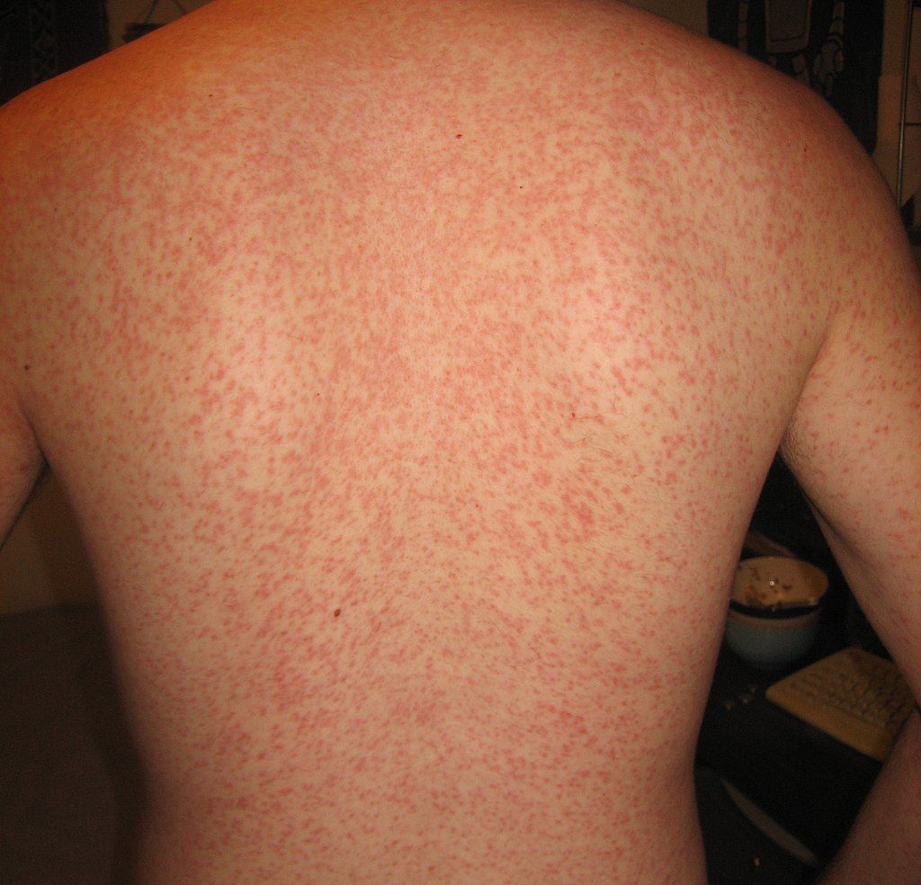 rash on skin not itchy