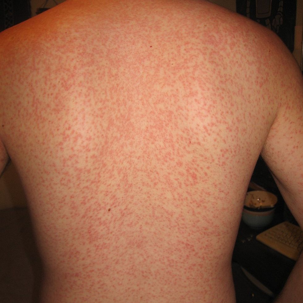 Skin Rash, Urticaria, Allergic Skin Reaction. Stock Image - Image of  allergist, irritated: 93000603