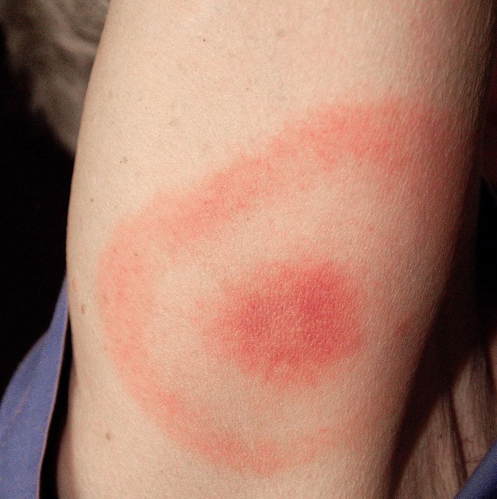 tick bite bullseye rash