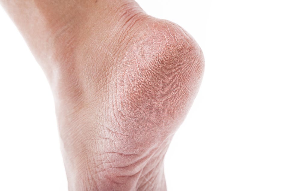Dry Skin