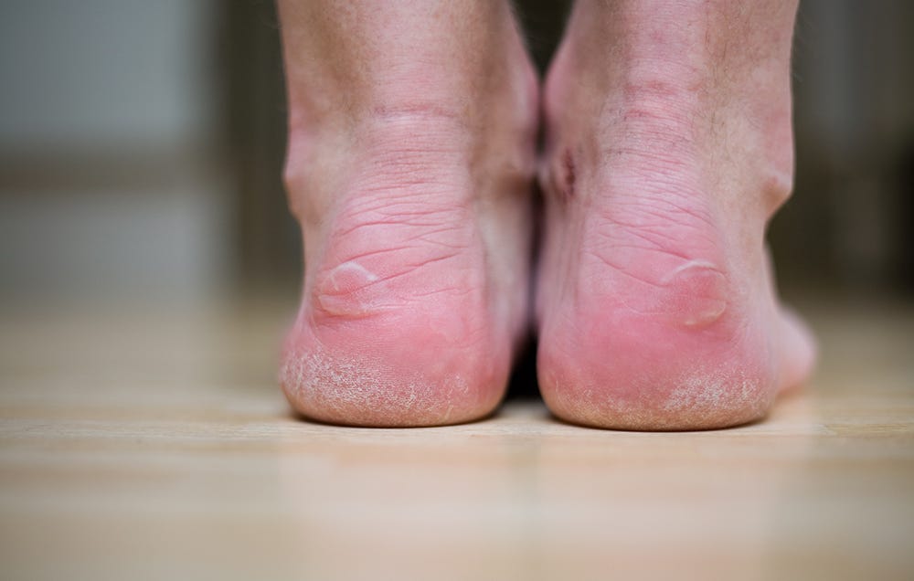 blisters