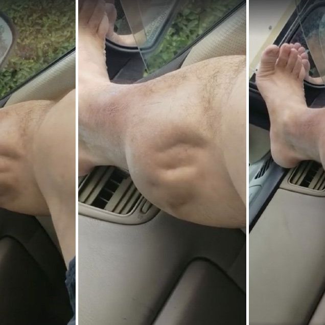 leg cramp bursts skin