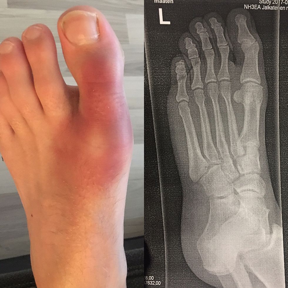 Runyon’s foot after the Rovaniemi 66K Arctic Ultra. 