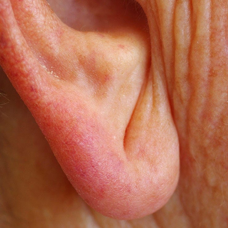 weird earlobe wrinkle