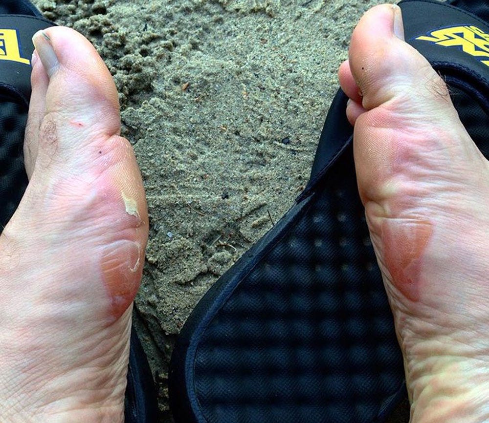 Tommy Layman's blister