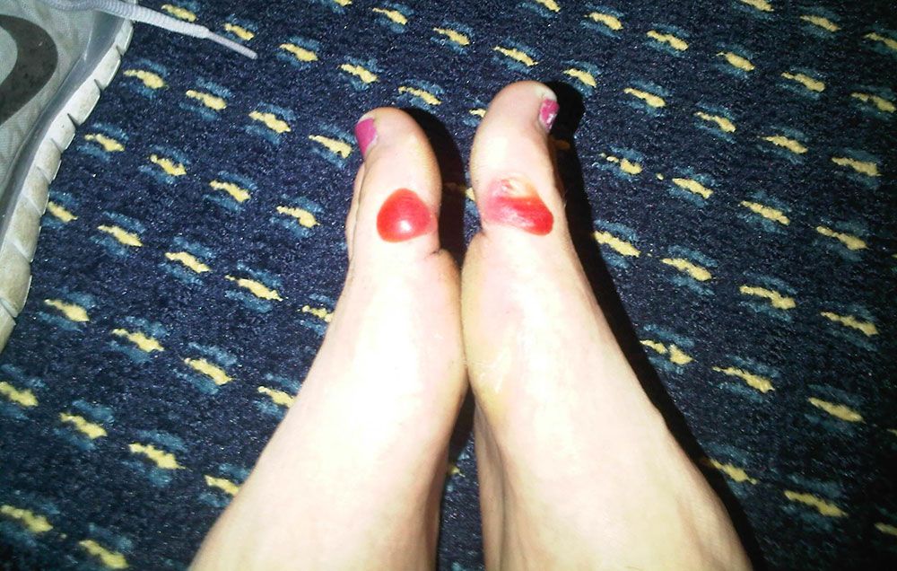 Jessica Wilhite's blister
