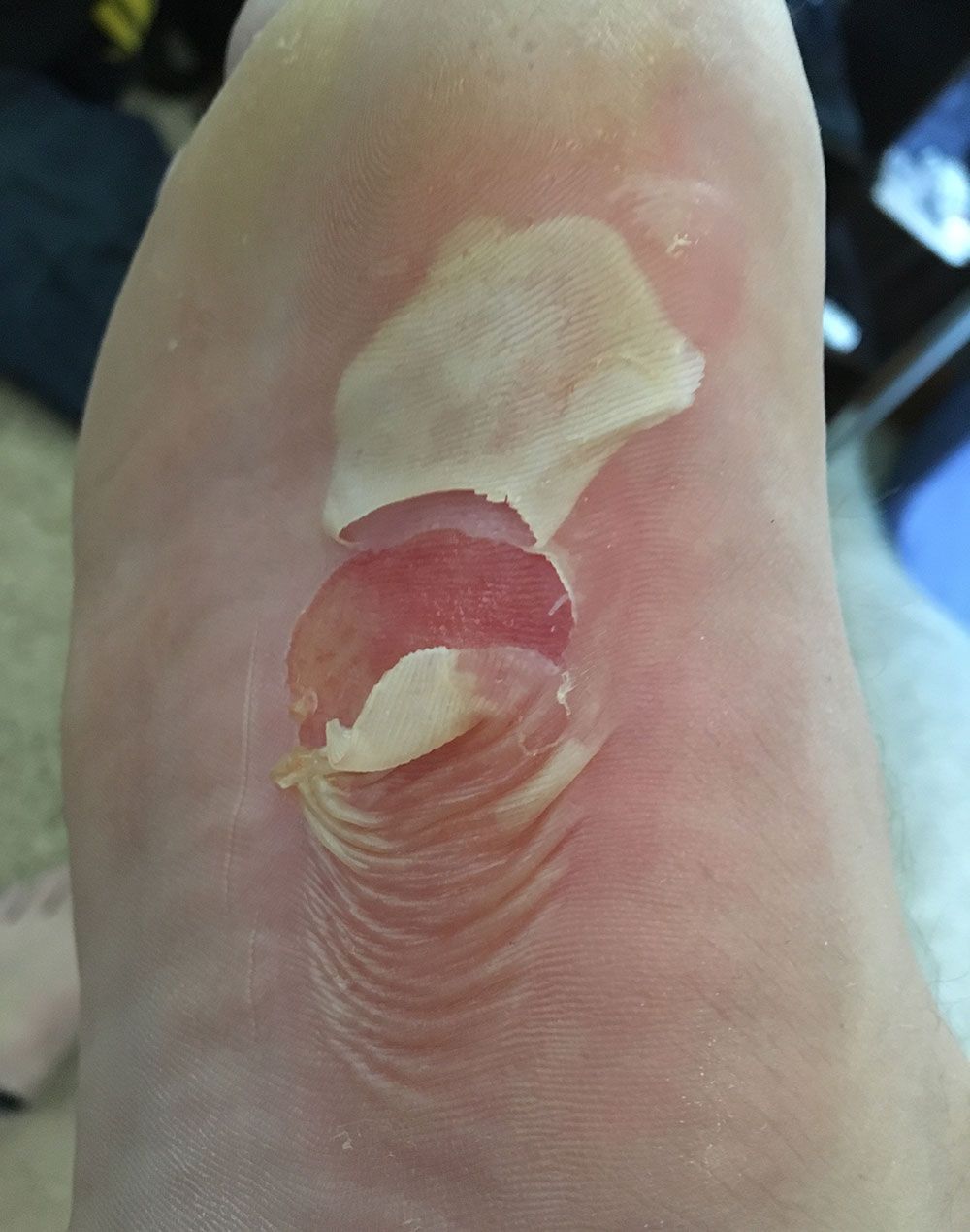 Trevor Grandgenett's blister