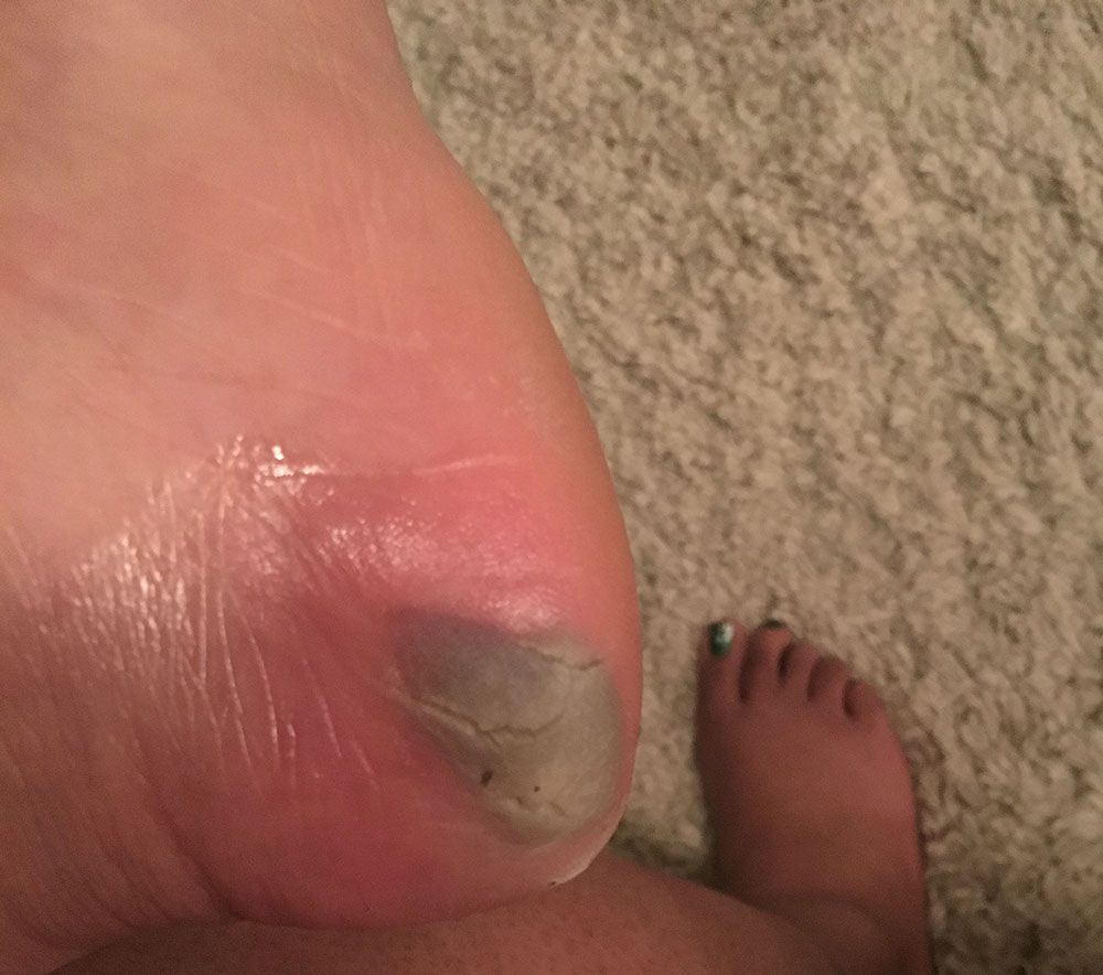 Angelique's blister