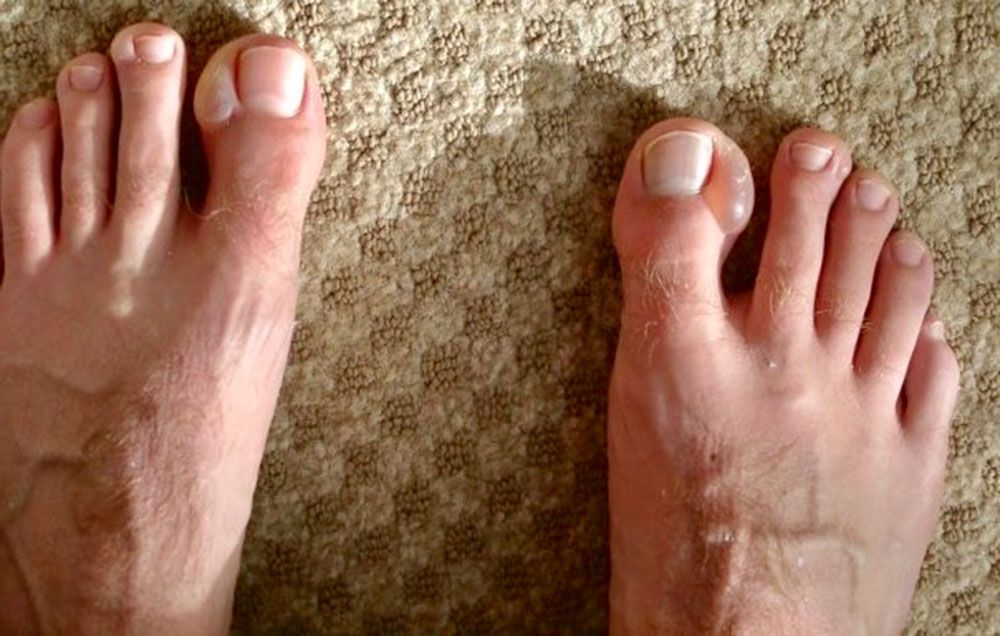 Tom Connor's blister
