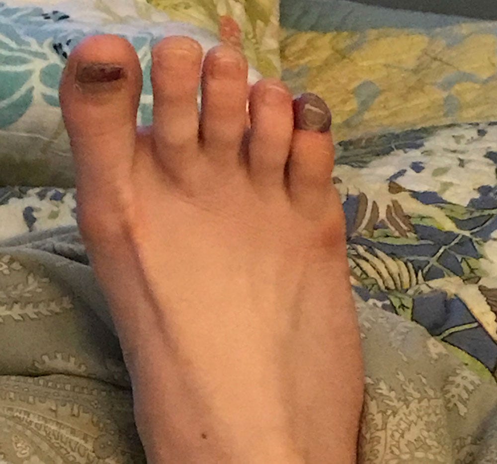 Doria's blister