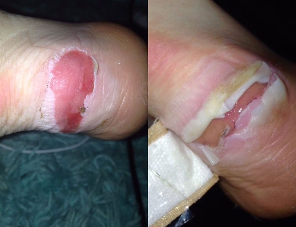 Bridget Mitchell's blister
