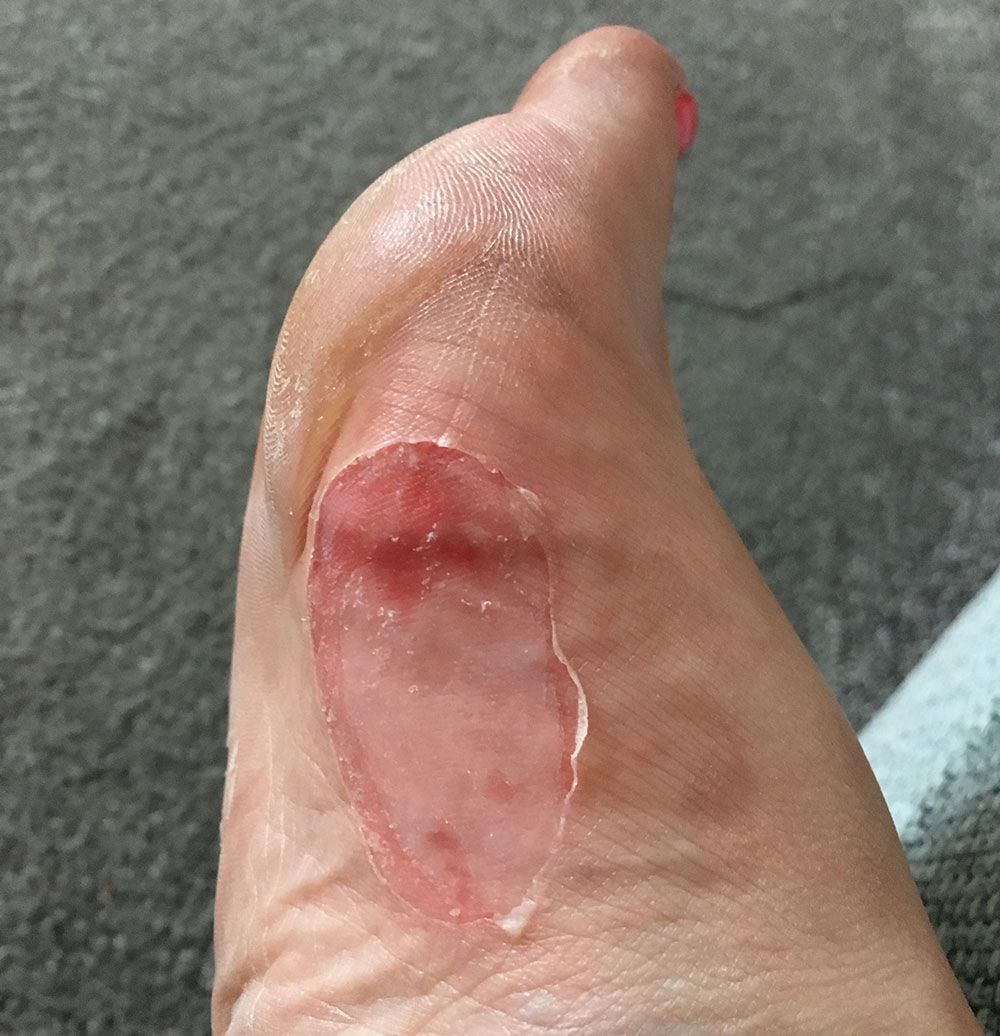 Big blister on on sale heel