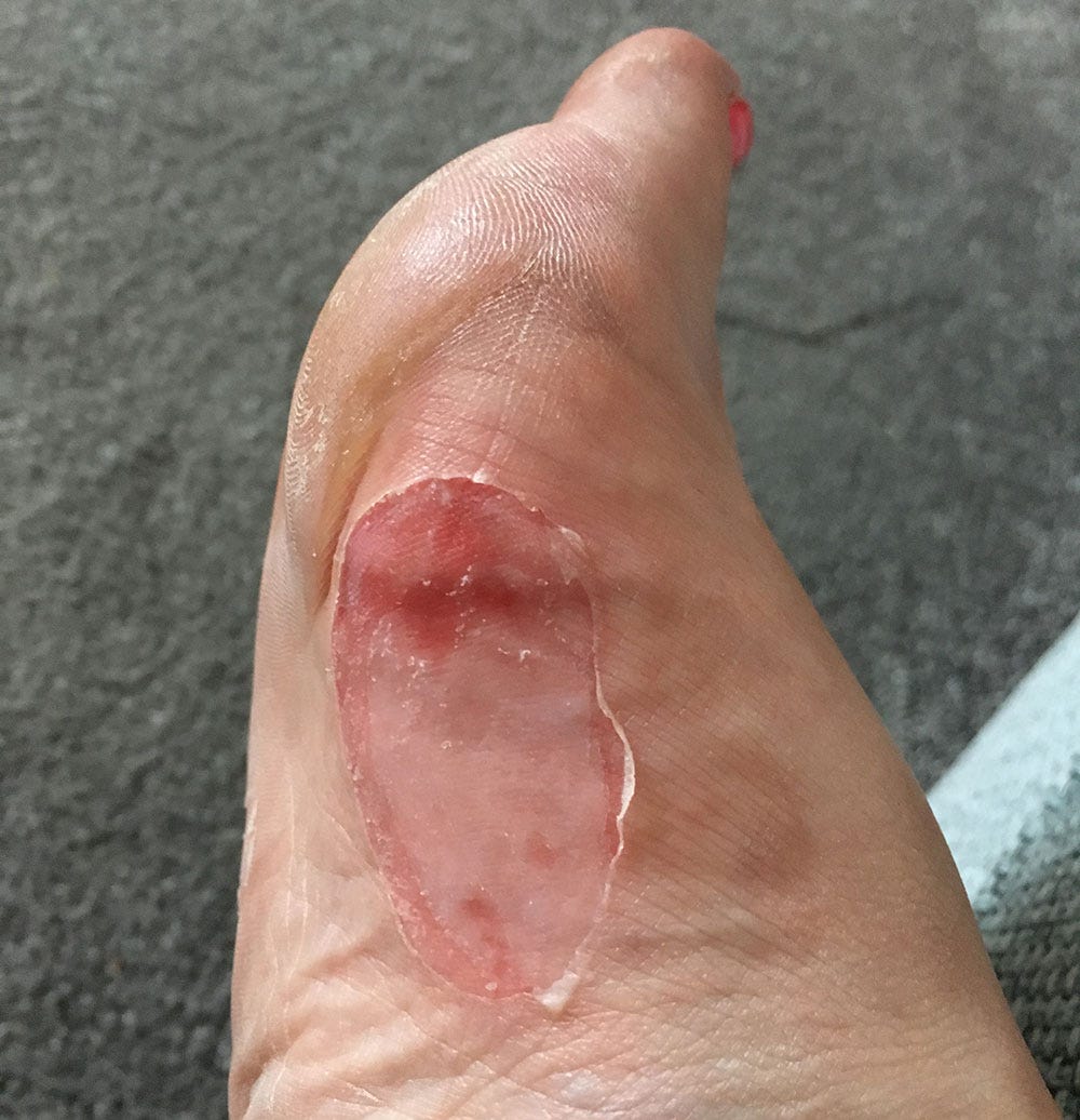 Jackie Gourley's blister