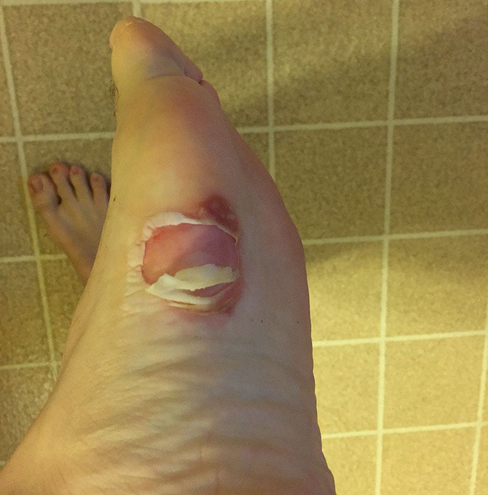 Chase's blister