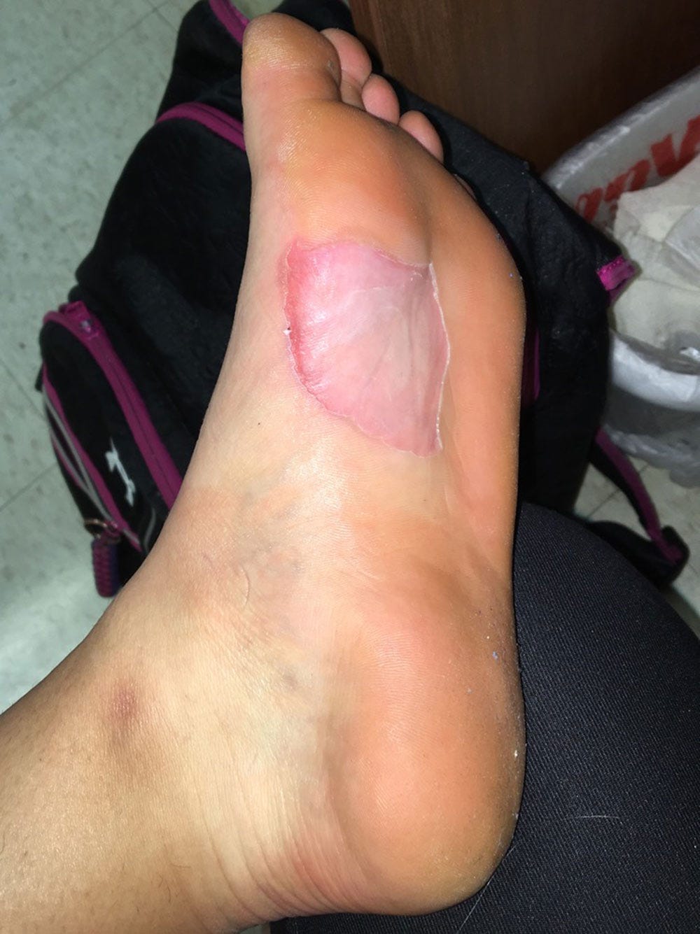 Haley Fye's blister