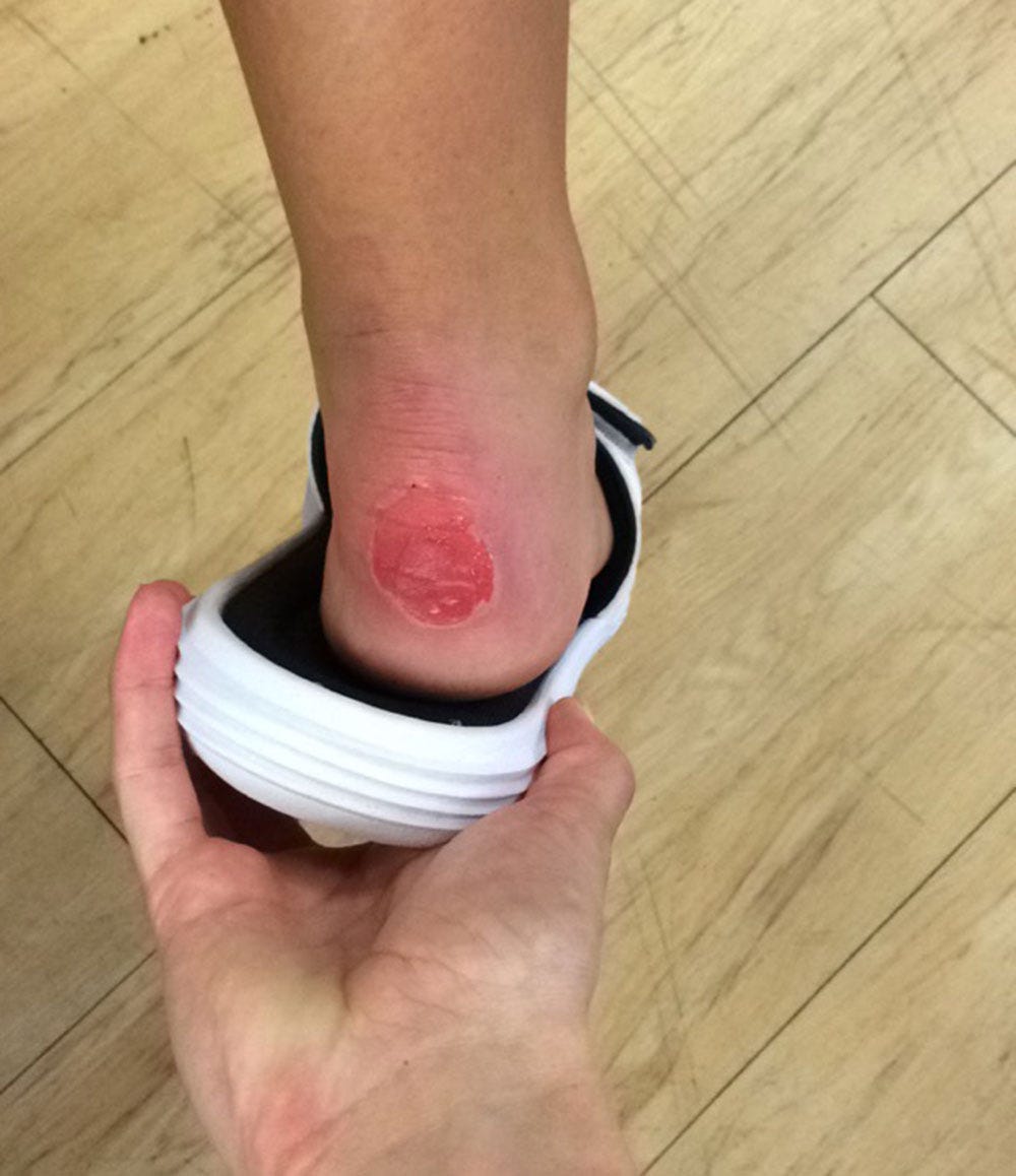 Holly Wisnousky's blister