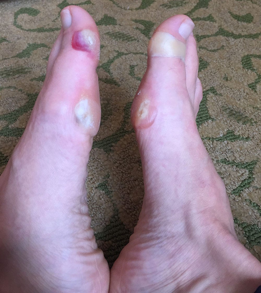 Stacy Dixson's blister