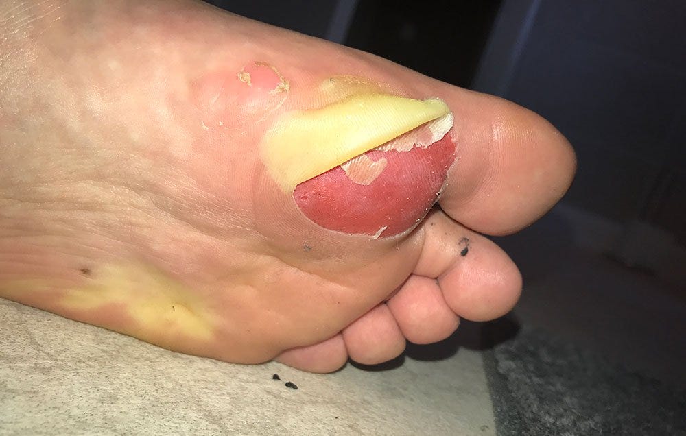 Daniel Burne's blister