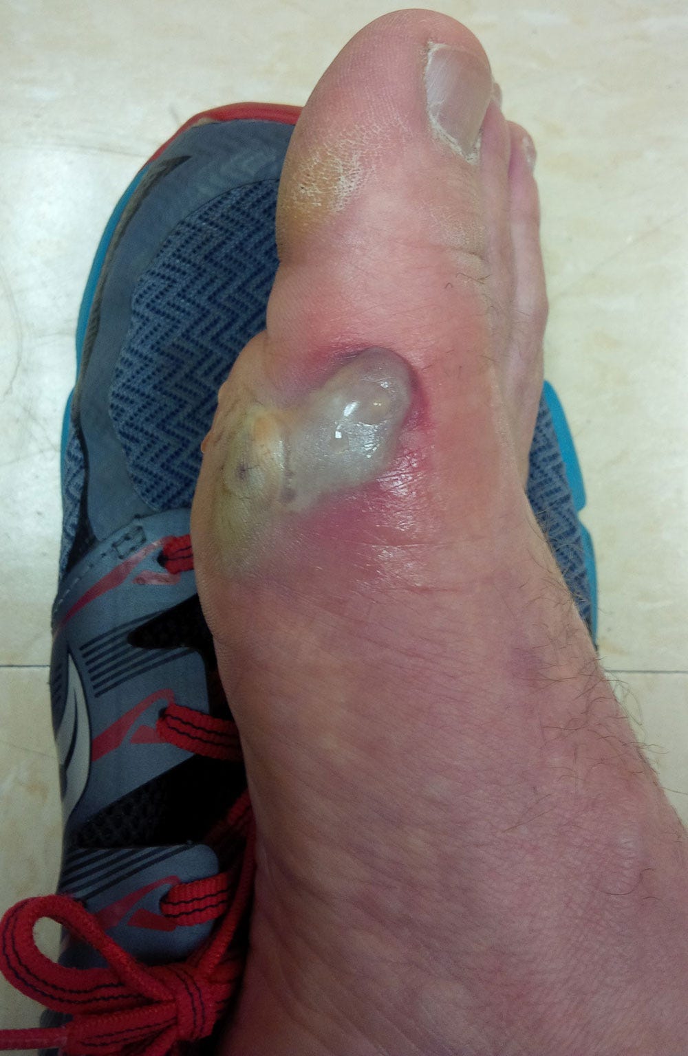 Russ's blister