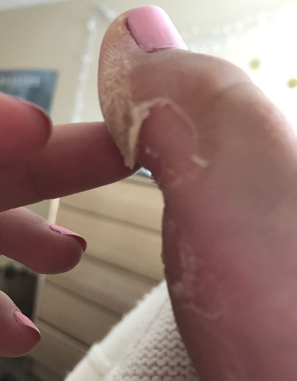 Nicole S.'s blister