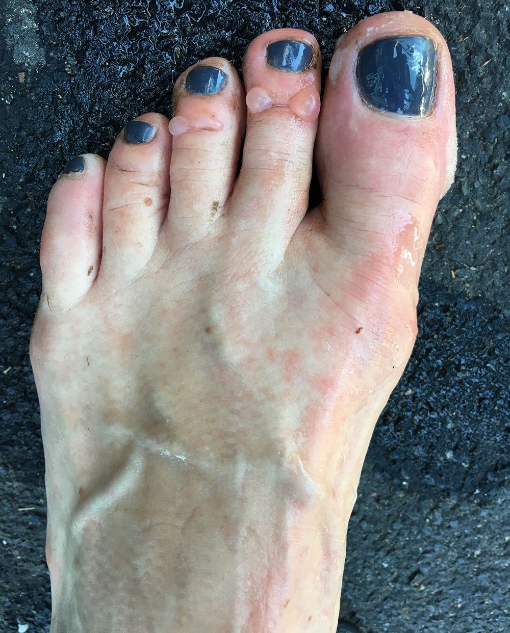 Lisa Engler's blister