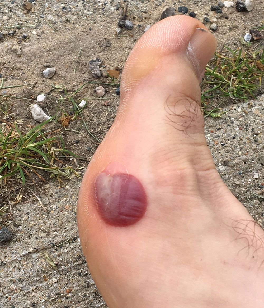 Heel clearance blood blister