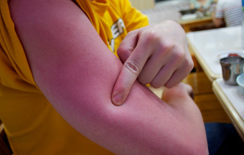 Sunburn