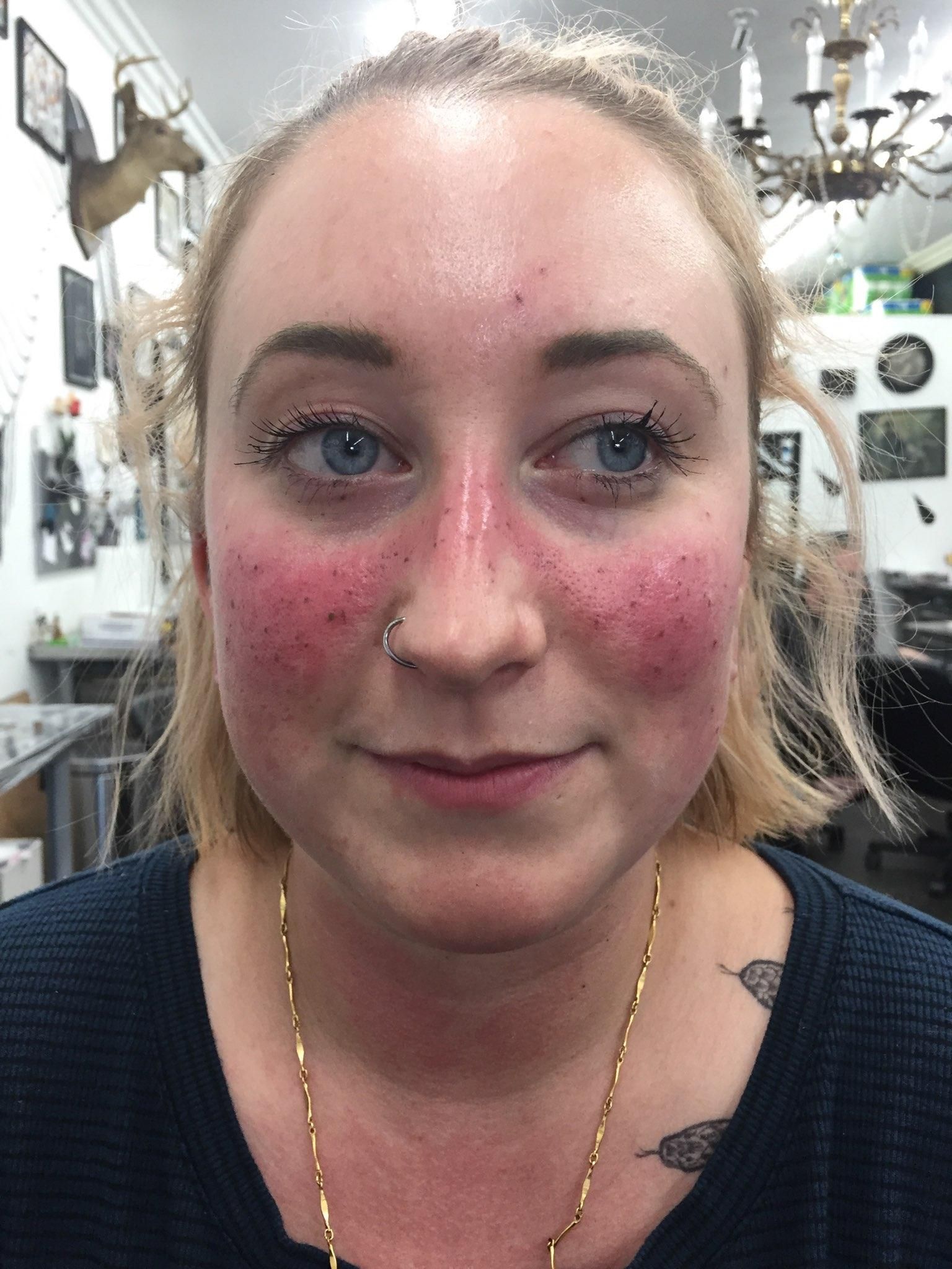 This Beauty Trend Has A Tattooist Blade Freckles Onto The Patients Face  All Inspired By Meghan Markle  Media Drum World